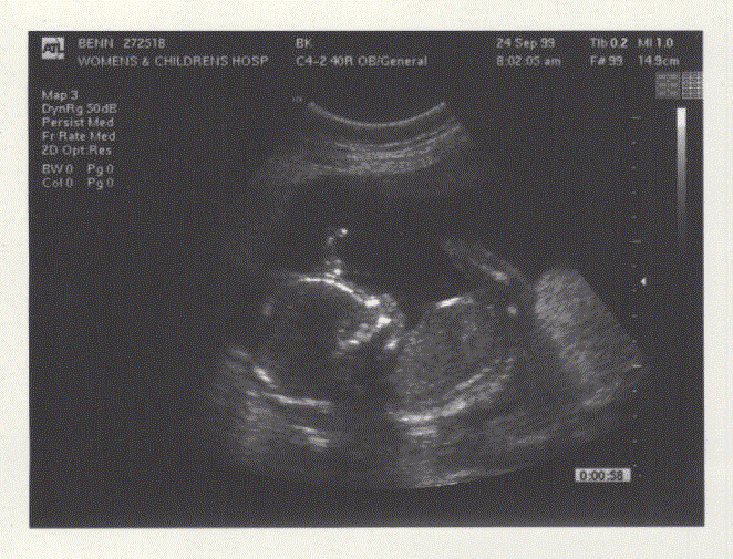 Ultrasound image